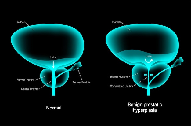 Bph info concept