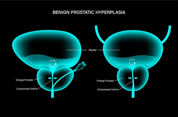 BPH info concept