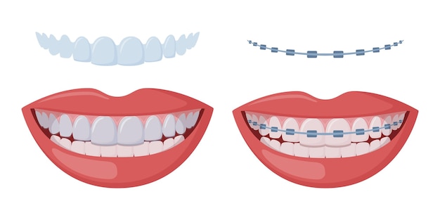braces corrective orthodontics smiling female mouth with healthy teeth and braces