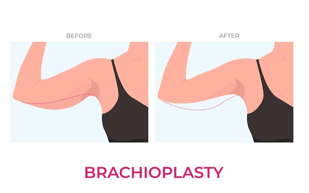 Brachioplasty 또는 상완 리프트 여자의 성형 수술 정면보기