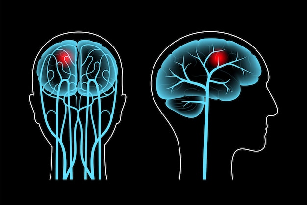脳卒中、出血性および虚血性の問題。人間の頭の痛み。