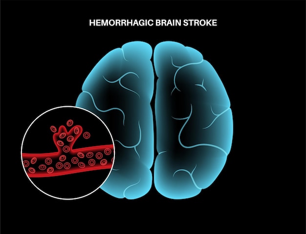 Vector brain stroke hemorrhagic