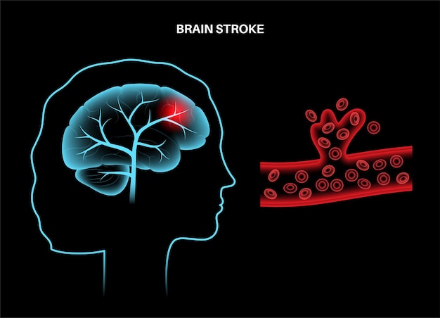 Vector brain stroke hemorrhagic