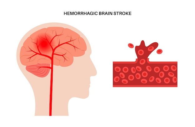 Brain stroke hemorrhagic