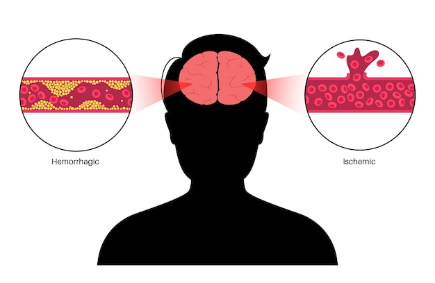 ベクトル 脳卒中は虚血性および出血性