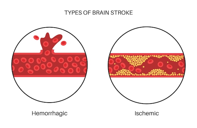 脳卒中は虚血性および出血性