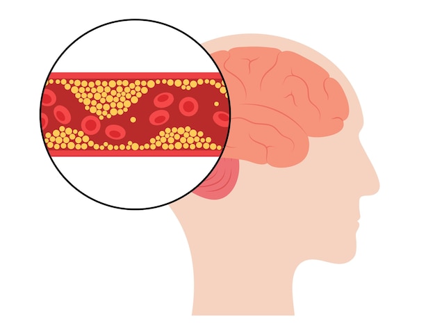 Vector brain stroke ishemic