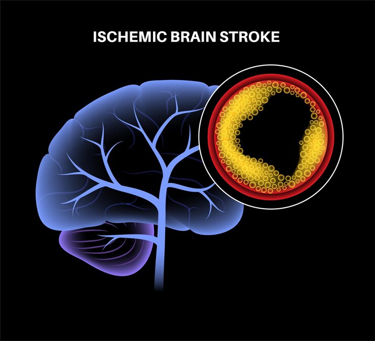 Vector brain stroke ishemic