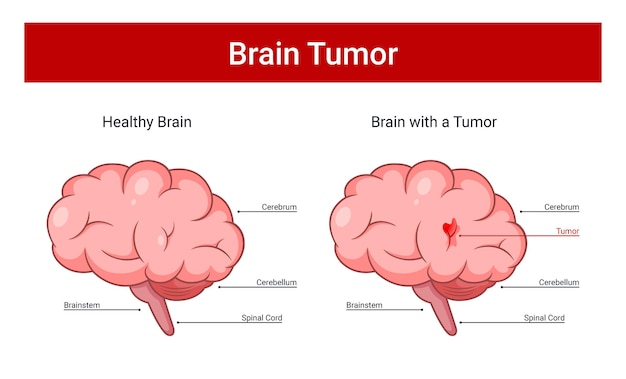 脳腫瘍のベクトル図、健康な脳と病気の脳腫瘍のイラスト
