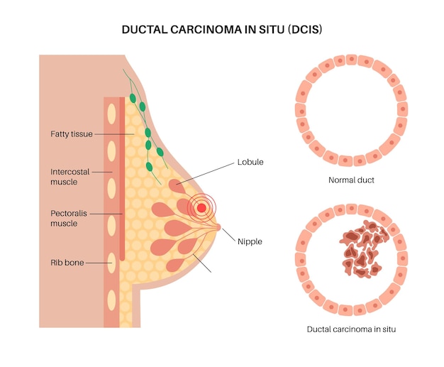 Vettore il mese di sensibilizzazione sul cancro al seno