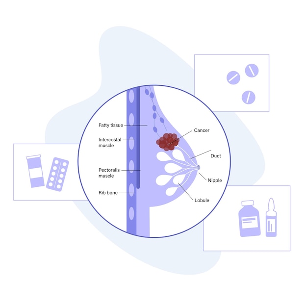 Vector breast disease concept