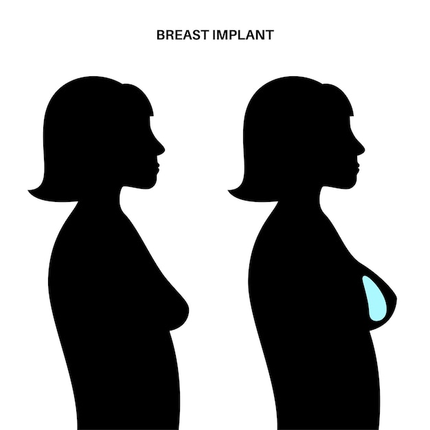 Breast Implant Concept