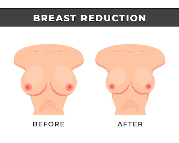 Breast reduction result before and after