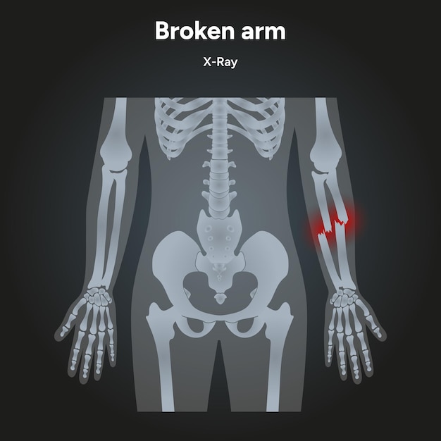Vector broken arm x ray