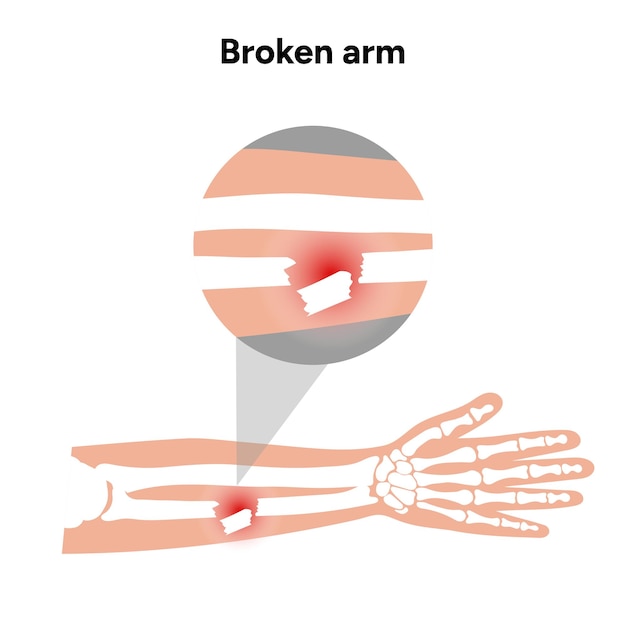 Vector broken arm zoom