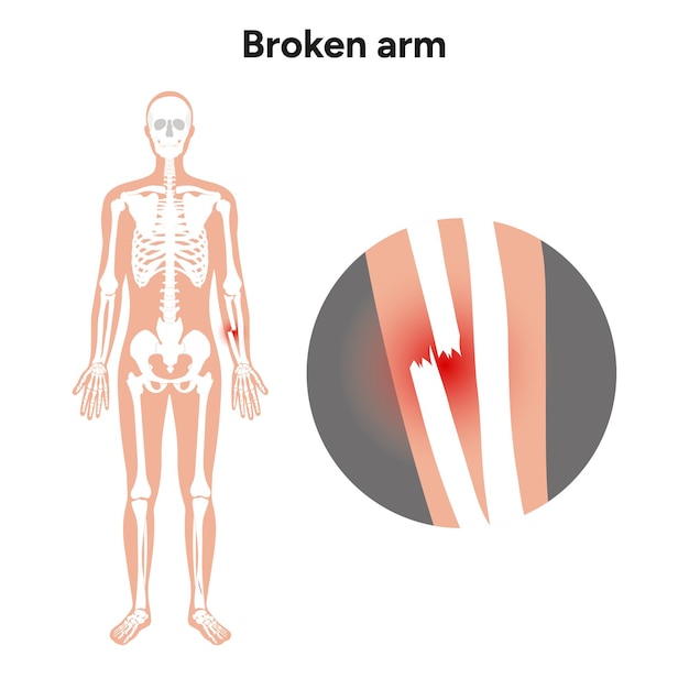 Vector broken arm zoom