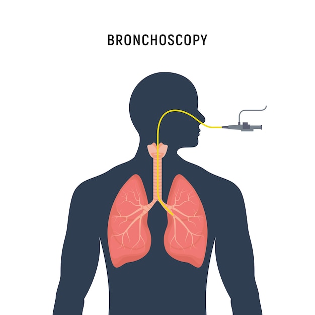 Bronchoscopie ademhalingssysteem emfyseem endoscopie menselijke longonderzoek Bronchoscopie icoon