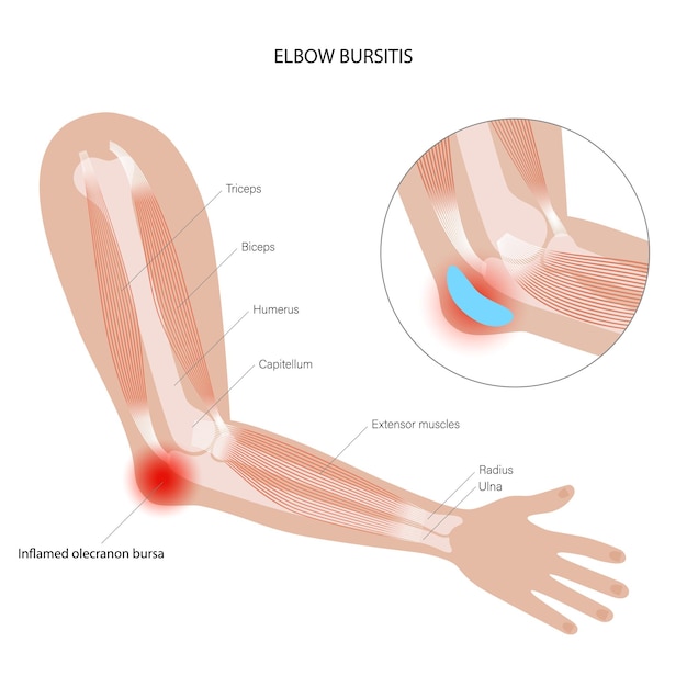 Bursitis bij studentenelleboog