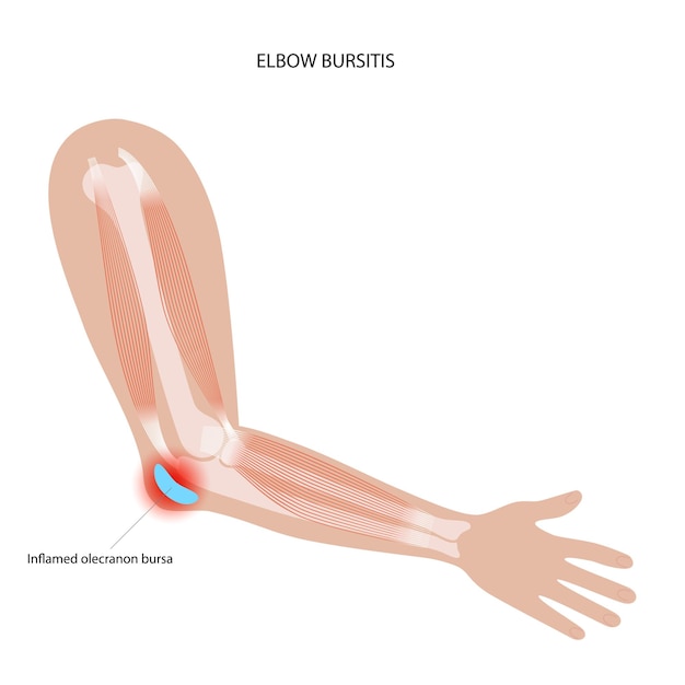 Bursitis bij studentenelleboog