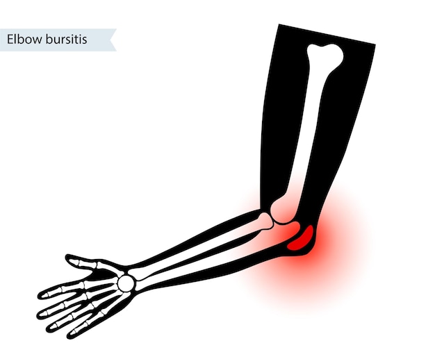 Bursitis bij studentenelleboog