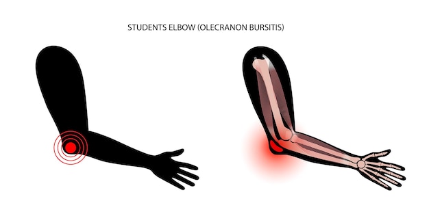 Bursitis bij studentenelleboog