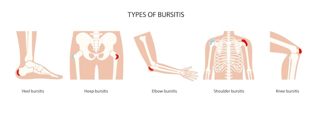 Vector bursitis icons set