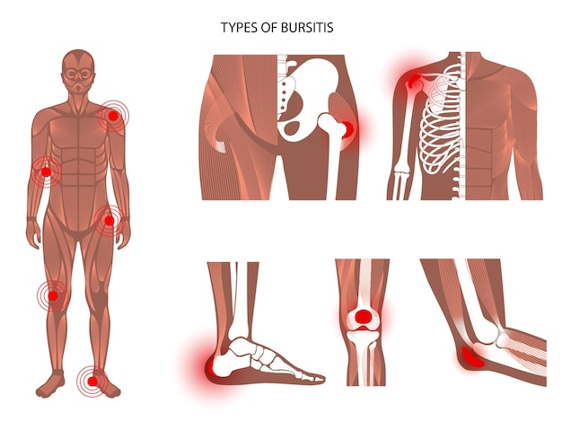 Vector bursitis icons set