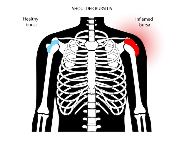 Vector bursitis inflammation concept