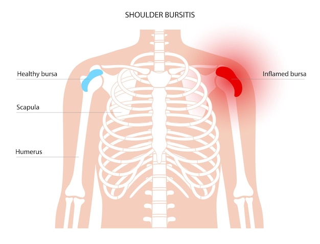 Vector bursitis inflammation concept