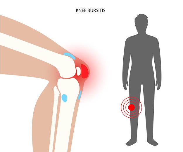 Bursitis inflammation concept