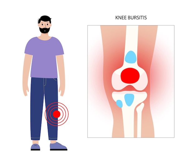 Vector bursitis inflammation concept