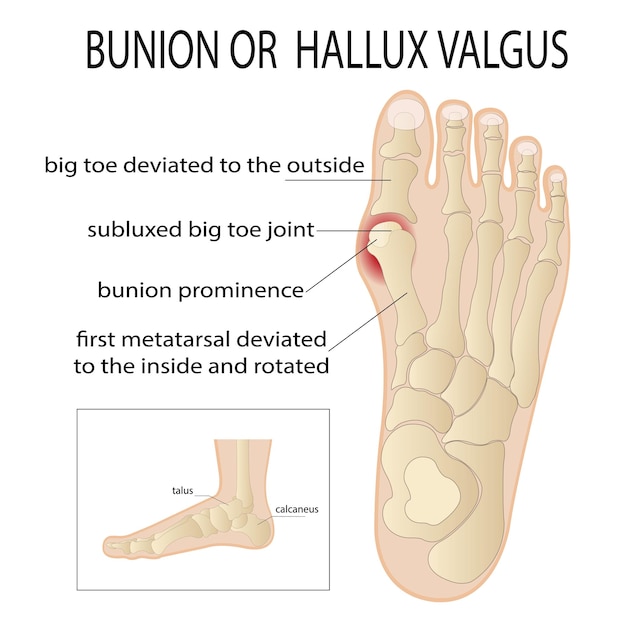 발 측면의 활액낭염은 엄지발가락 관절 측면의 뼈와 피부가 기형을 형성합니다.