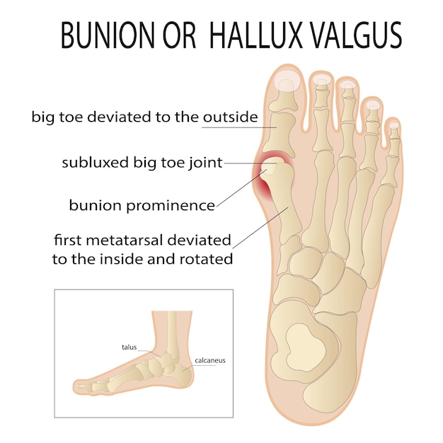 Вектор Бурсит по бокам стопы кость и кожа по бокам сустава большого пальца образуют абнор