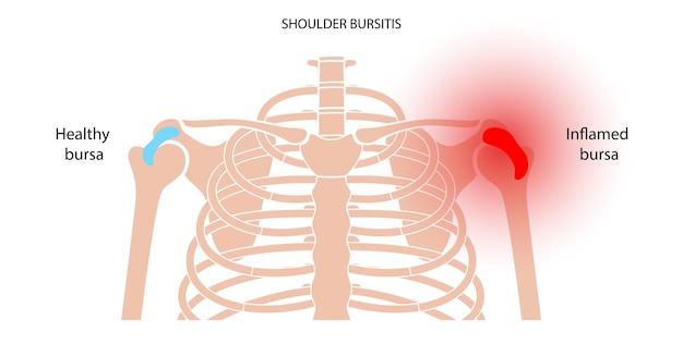 Bursitis ontsteking concept