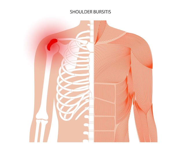 Bursitis ontsteking concept