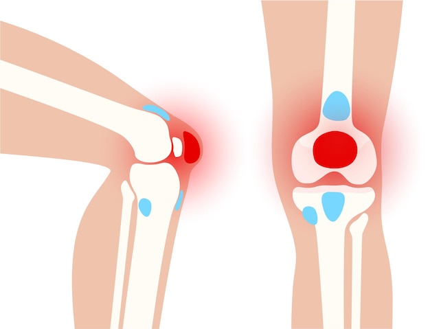 Bursitis ontsteking concept