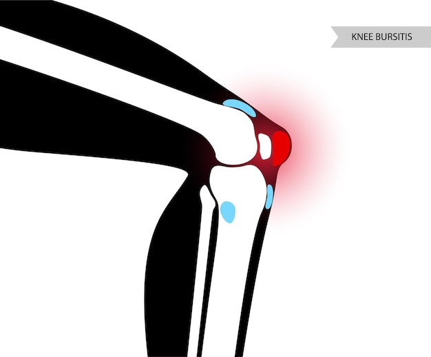 Bursitis ontsteking concept