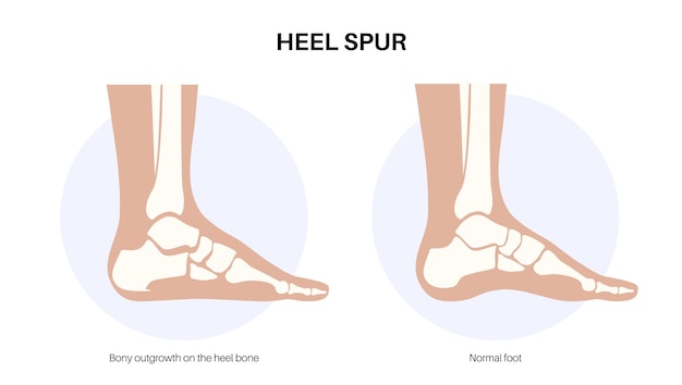 Calcaneal spur anatomy Foot problem diagnostic and treatment in podiatry clinic Heel bone outgrowth from calcaneal tuberosity Ankle pain and swelling X ray examination of feet vector illustration