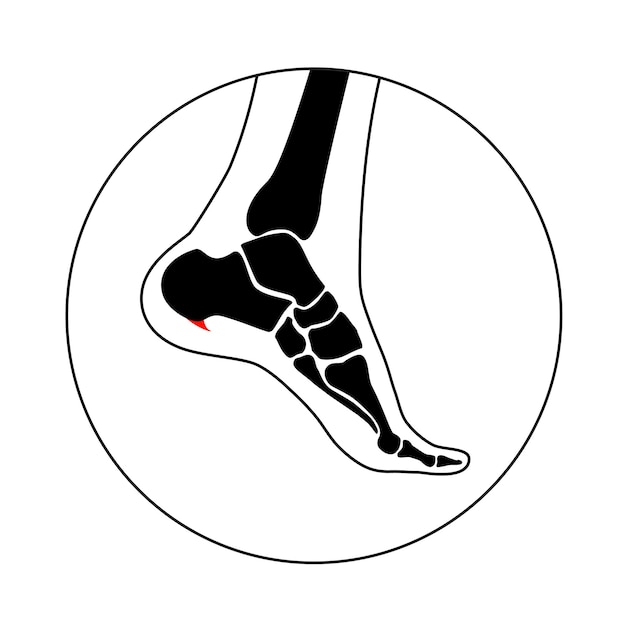 Calcaneal spur icon foot problem diagnostic and treatment in a podiatry clinic heel bone outgrowth from calcaneal tuberosity ankle pain and swelling x ray examination of feet vector illustration