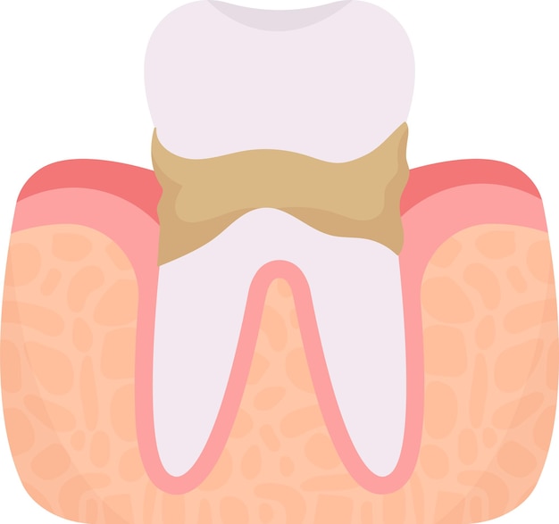 Calculus tooth problem