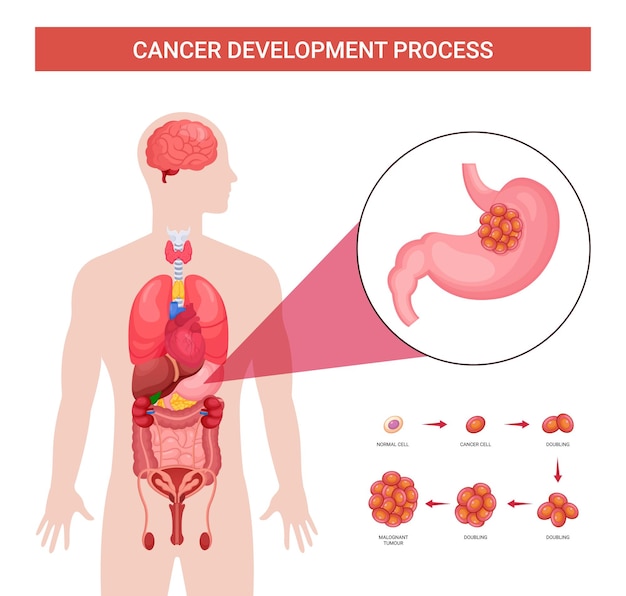 Progettazione infografica del processo di sviluppo del cancro