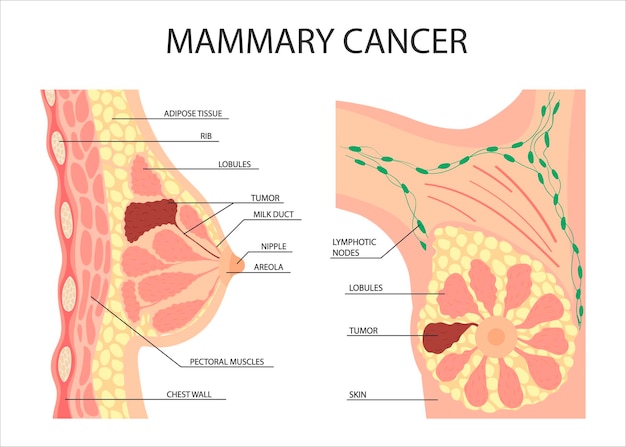 Cancro al seno femminile un tumore o crescita nel seno umano