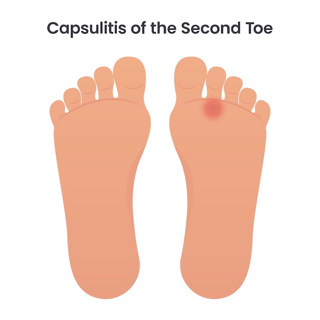 Capsulitis of the Second Toe medical vector illustration graphic