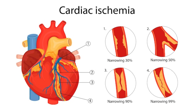 Ischemia cardiaca. illustrazione anatomica disegnata in stile cartone animato