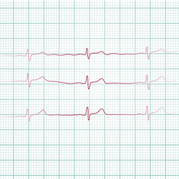 Кардиограмма Сердцебиение Линия сердцебиения Электрокардиограмма Вектор