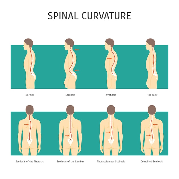 척추 측만증 카드 포스터 척추 인간 건강 관리 개념 요소 평면 디자인 스타일 벡터 일러스트와 함께 다시 만화