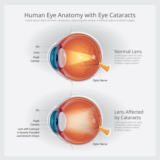 Vector cataracts vision disorder and normal eye vision anatomy illustration