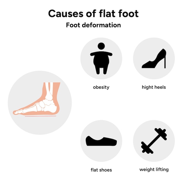 Vector causes of flat foot