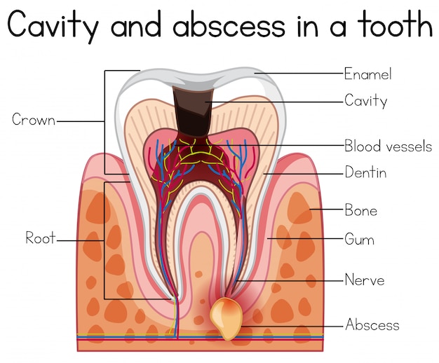 Vettore cavità e ascesso in un dente