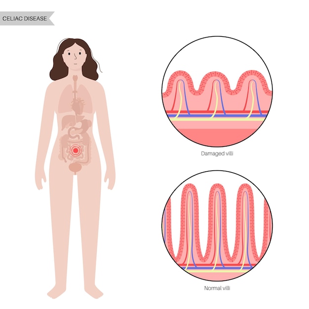 체강 질병. 장벽 표면의 손상되고 건강한 장 융모.